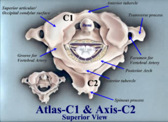 Sublussazione dell'Atlante
