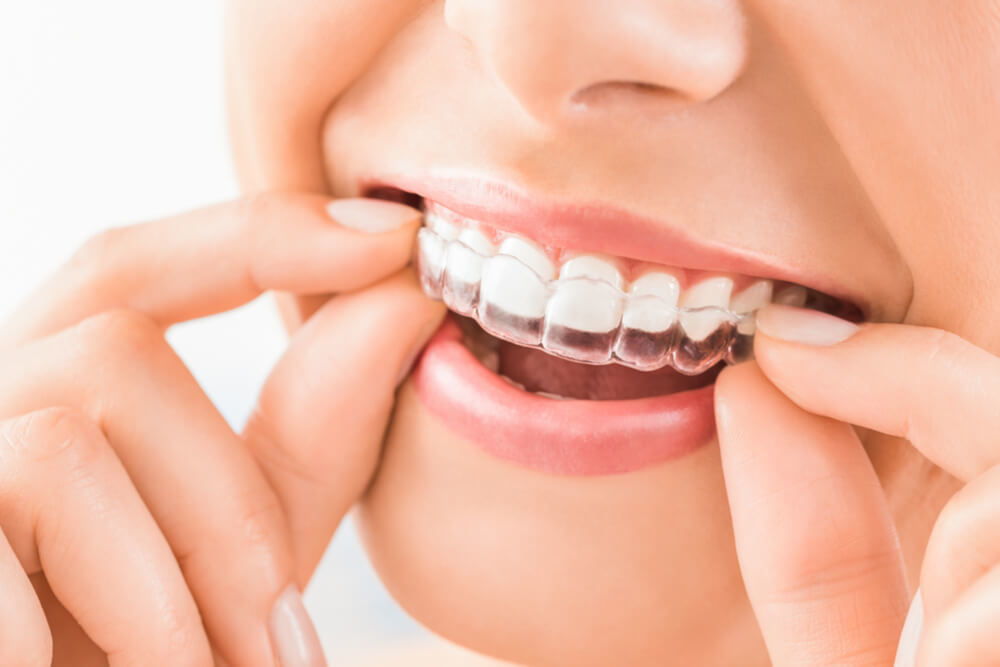 Bite dentale