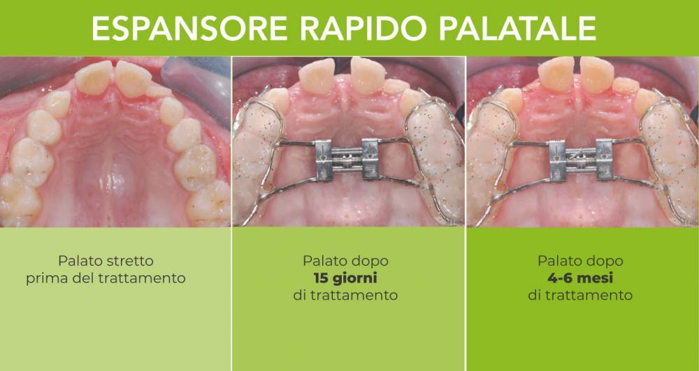 Espansore rapido del palato